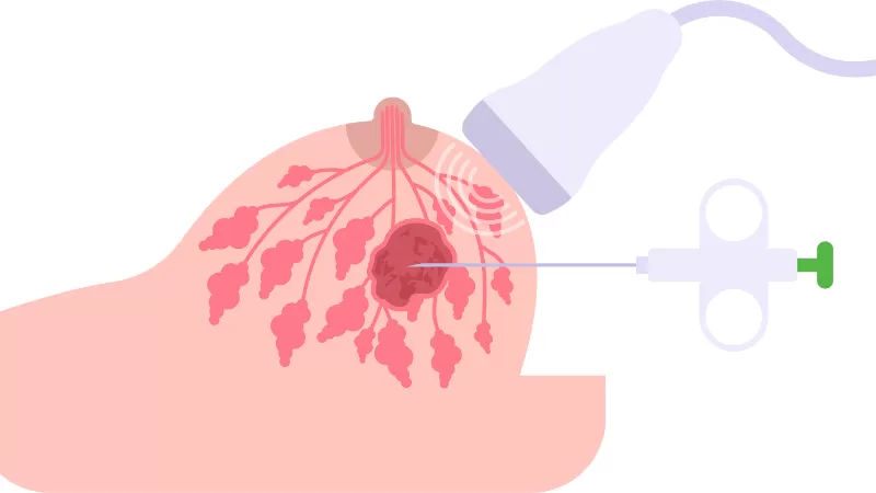 Sinh thiết lõi kim