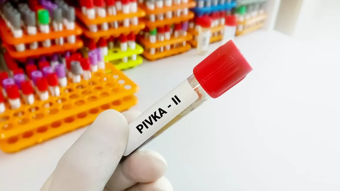PIVKA-II: Bước đột phá trong tầm soát và chẩn đoán Ung thư biểu mô tế bào gan (HCC)