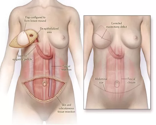 Vi phẫu tái tạo vú bằng vạt mô tự thân trong ung thư vú