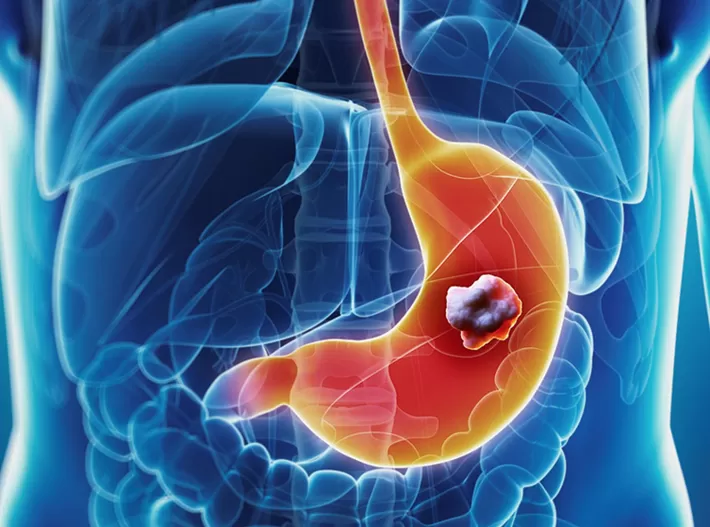 Gói khám sức khỏe định kỳ và phát hiện sớm ung thư dạ dày - thực quản