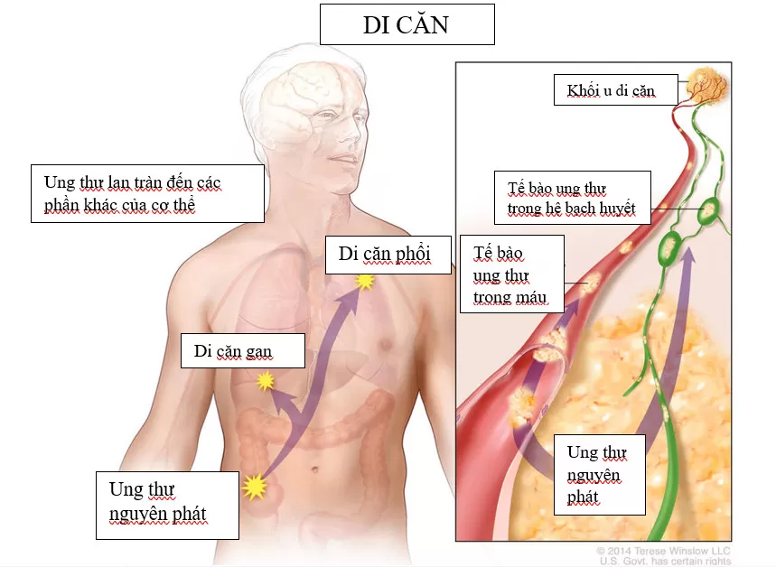 Trả lời: Ung thư di căn là gì? Có chữa được không?