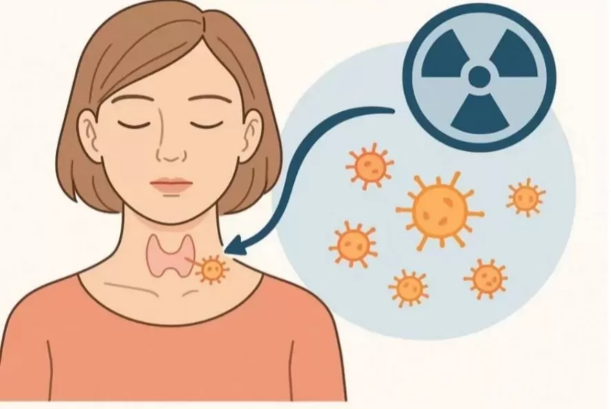 Câu hỏi: Điều trị ung thư tuyến giáp bằng i-ốt phóng xạ là gì?